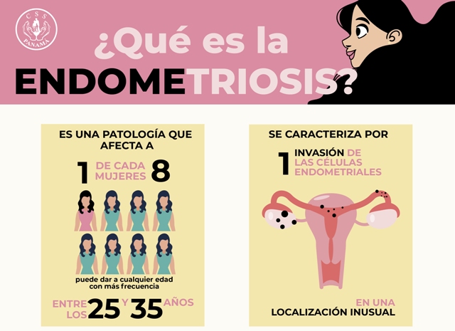 Endometriosis ¿qué Es Y Cómo Afecta La Vida De La Mujer Css Noticias 8274